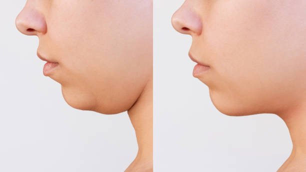 Double Chin Removal in Abu Dhabi