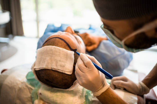 Hair Transplant in Riyadh